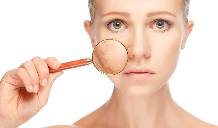 How to Remove Freckles and Dark Spots